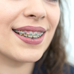 Bild zeigt Patientin mit festsitzender Zahnspange Bild zeigt Patientin mit festsitzender Zahnspange