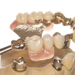 Bild zeigt einen Zahnersatz Bild zeigt einen Zahnersatz